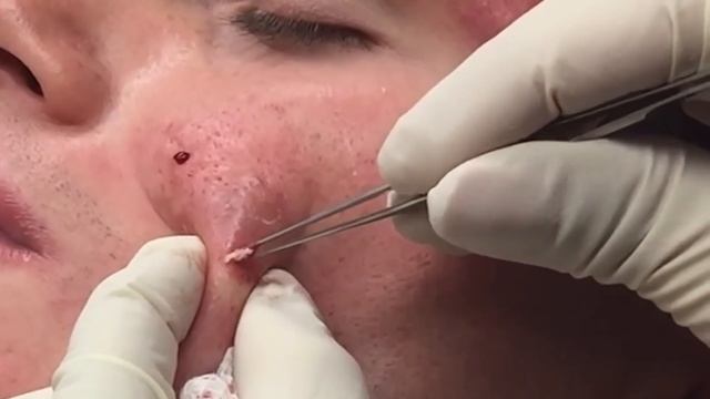 The Beautiful Blackheads | Dr Pimple Popper: This Is Zit смотреть онлайн