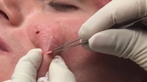 The Beautiful Blackheads |  Dr Pimple Popper: This Is Zit