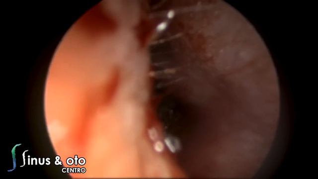 Myiasis Of The Ear