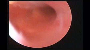 Гистероскопия+резектоскопия Синехии.