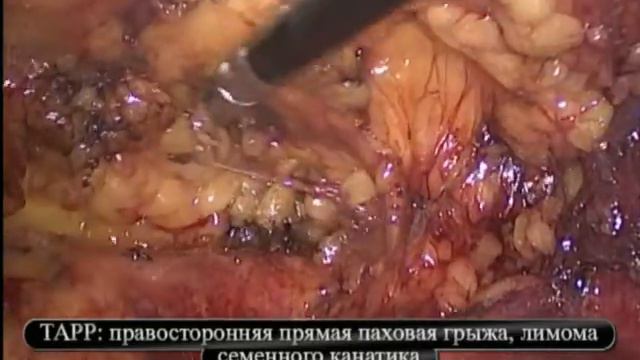 TAPP паховая грыжа+липома смотреть онлайн