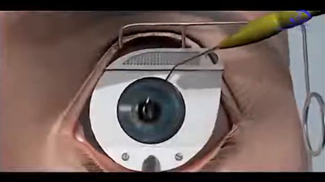 Лазерная коррекция зрения SUPER LASIK смотреть онлайн