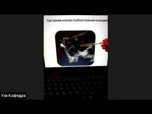 УЗИ Правых отделов сердца Малыхина Е С