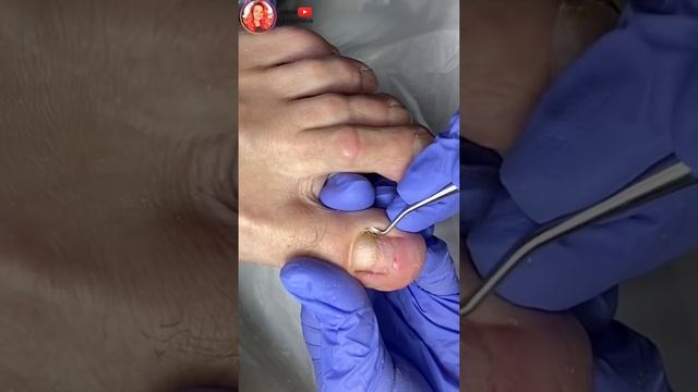 Онихолизис ногтей на ногах смотреть онлайн