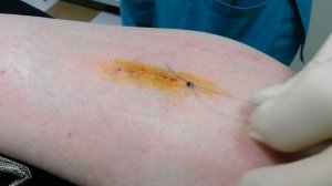 Снятие косметического шва после удаления липомы