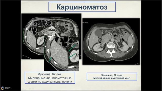 Опухоли пищевода и желудка 3 смотреть онлайн
