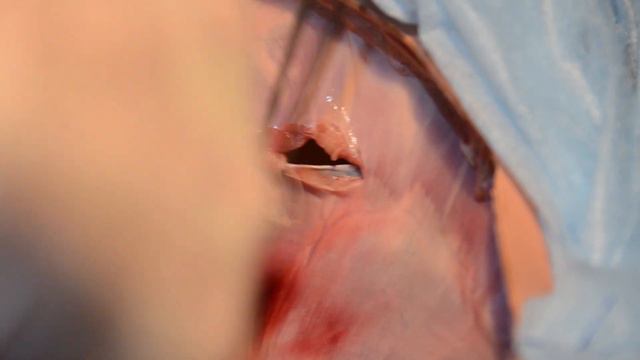Травма диафрагмы. Ушивание разрыва диафрагмы смотреть онлайн