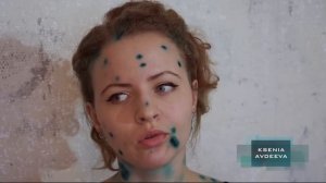 Ветрянка у взрослых