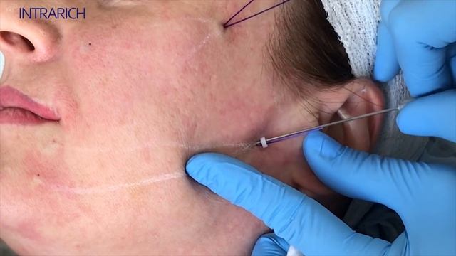 Армирование средней трети лица мезонитями INTRARICH на канюле смотреть онлайн