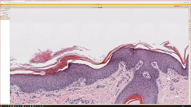 Tinea Versicolor/Pityriasis Versicolor (Malassezia Aka Pityrosporum Skin Infection) Dermatology