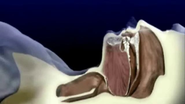 Механизм возникновения обструктивного апноэ сна смотреть онлайн