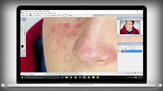 How To Remove Acne Pimples in photoshop 7.0 смотреть онлайн