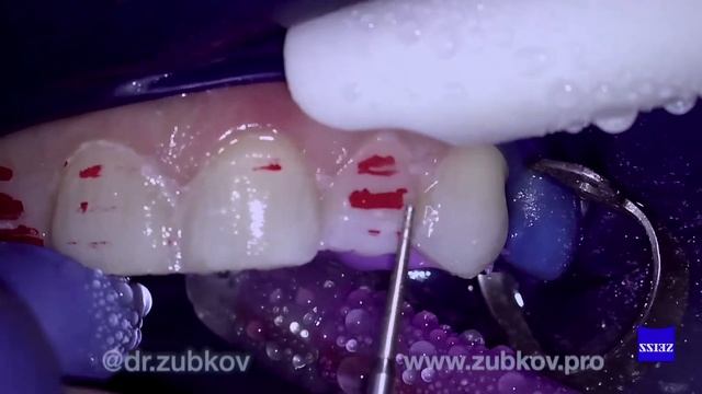 Изготовление виниров КУРСК 2019 смотреть онлайн