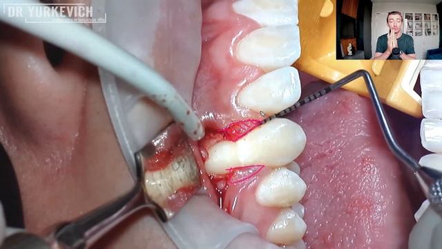 Лечение рецессии десны методом КСЛ // Coronally advanced flap for single gum recession treatment смотреть онлайн
