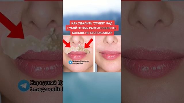 как удалить усики над губой чтобы растительность больше не беспокоила #рецепт #здоровье #медицина смотреть онлайн