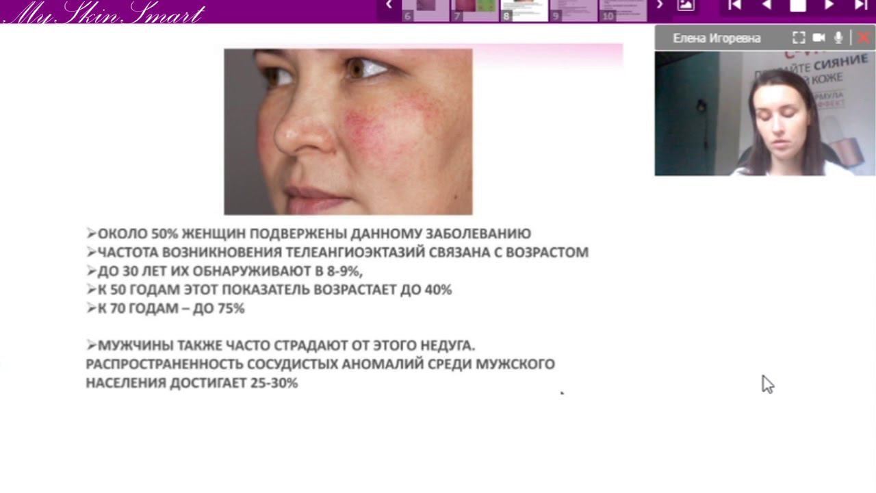 Лекция 11. Купероз. ТАЭ. Розацеа. Периоральный дерматит смотреть онлайн