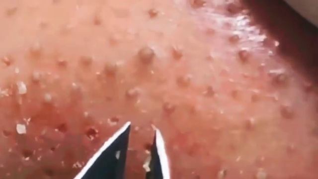 ✅ Чистка пор и выдавливание прыщей #14 смотреть онлайн