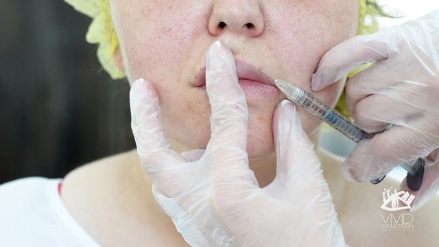 Процедура увеличения губ в Академии красоты VIVID CONVERSION