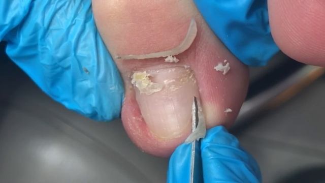 Elongated Ingrown Toenails, Thorough Treatment【Crazy Pedicure Room】