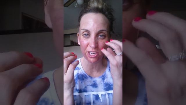 1 day post TCA 25% peel. смотреть онлайн