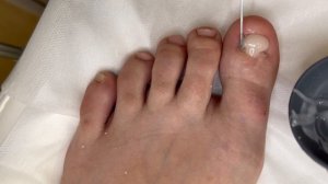 Протезирование ногтевой пластины нет ногтя протез