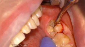 хирургия.удаление зуба мудрости