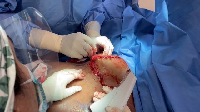 BREAST LIFT SURGERY смотреть онлайн