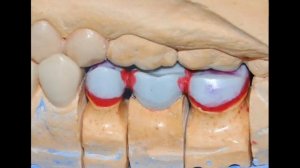 Изготовление металлокерамической коронки