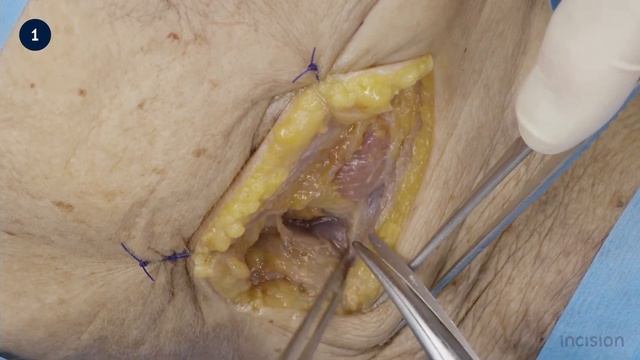 Submandibulectomy - How to perform a submandibular gland resection смотреть онлайн