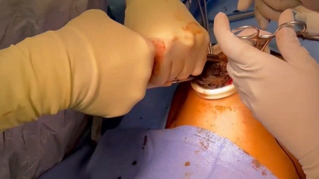 Open Removal Of Massive Trichobezoar In A Patient With Rapunzel Syndrome #Surgery #Laparotomy