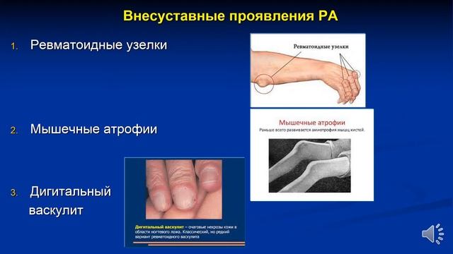 4 курс СФ. Лекция на тему: "Ревматоидный артрит". смотреть онлайн