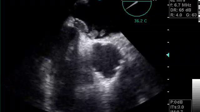 thrombus fosse ovale смотреть онлайн
