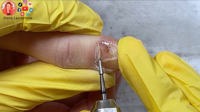 Прищемила палец дверью / Сошел ноготь на руке, что делать? смотреть онлайн