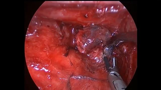 Right mediastinal lymph node dissection смотреть онлайн