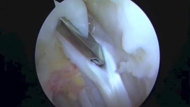 Loop Biceps Tenotomy: An Arthroscopic Technique for Long Head of Biceps Tenotomy смотреть онлайн