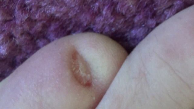 ЛЕЧЕНИЕ ОТ ГРИБКА 3 МЕСЯЦА 7 ДНЕЙ ИРУНИН смотреть онлайн