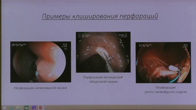 12 Агапов МЮ Перфорация при колоноскопии Причина Диагностика Тактика лечения смотреть онлайн