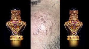 лечение прыщей   Удаление черных точек