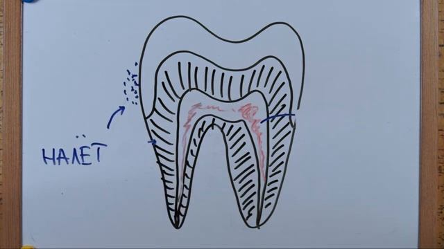 Кариес. Причины развития и методы профилактики. смотреть онлайн