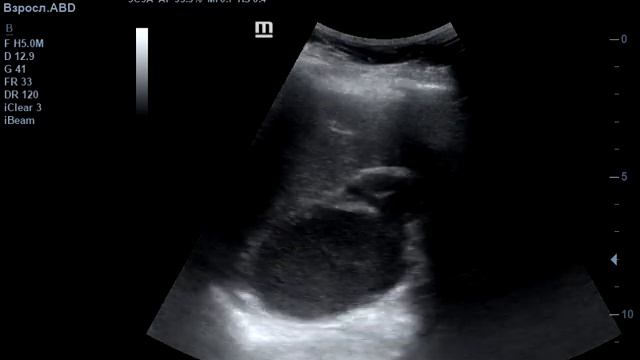 Образование в области ворот селезенки смотреть онлайн