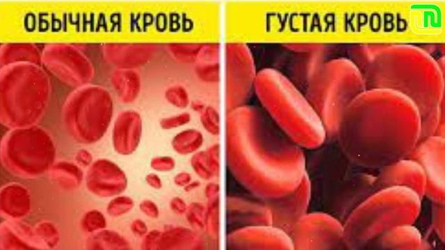 Что нужно делать, чтобы кровь свободно циркулировала | Густую кровь надо разжижать смотреть онлайн