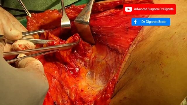 Axillary Lymph Node dissection || Level I,Il,III || Ductal Carcinoma of Breast|| смотреть онлайн
