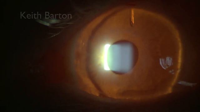 PRESERFLO MicroShunt In Ocular Albinism