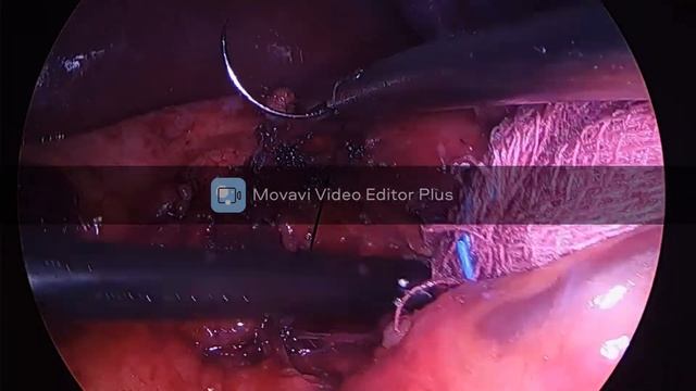 Грыжа пищеводного отверстие диафрагмы смотреть онлайн