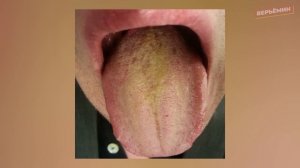 ЕСЛИ ТВОЙ ЯЗЫК ВЫГЛЯДИТ ТАК, БЕГИ К ДОКТОРУ!