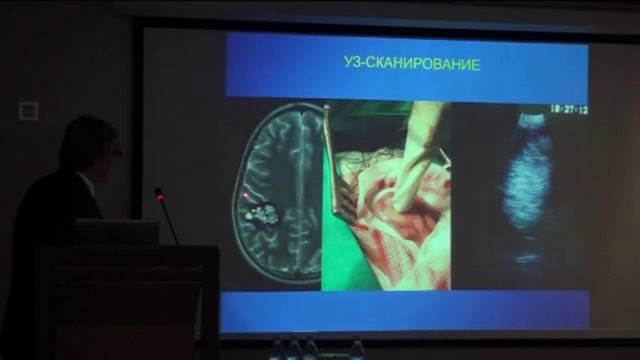 КАВЕРНОМЫ ЦНС Коновалов АН неврологию