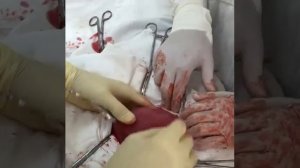 Удаление матки с гигантской миомой