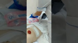 Как наклеить однокомпонентный калоприемник.