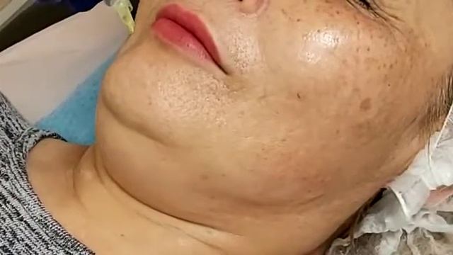 Мезотерапия для уменьшения подбородка и области брыль. смотреть онлайн