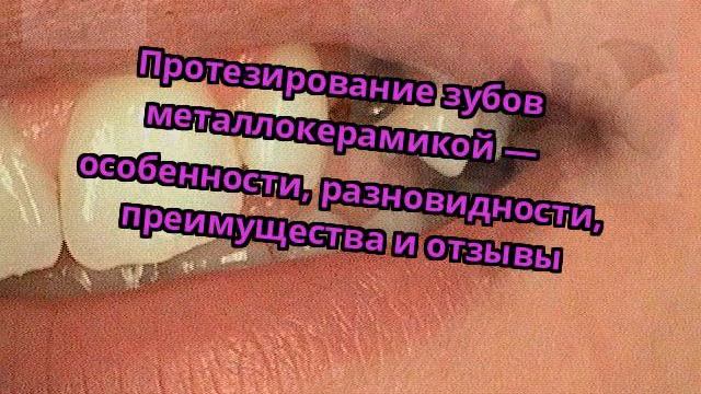 Протезирование зубов металлокерамикой — особенности, разновидности, преимущества и отзывы смотреть онлайн